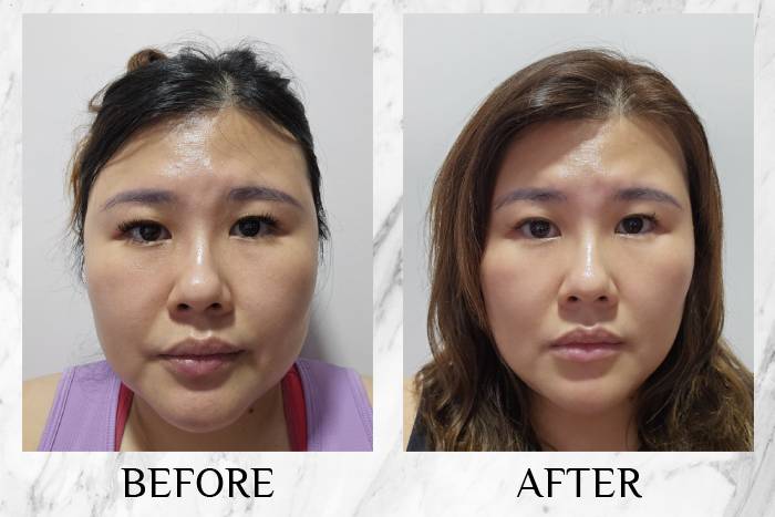 miriqa collagen reserve before after
