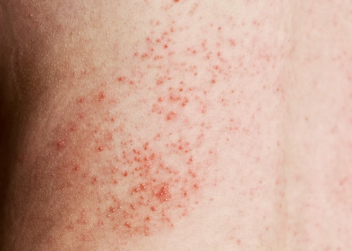 heat rash symptoms