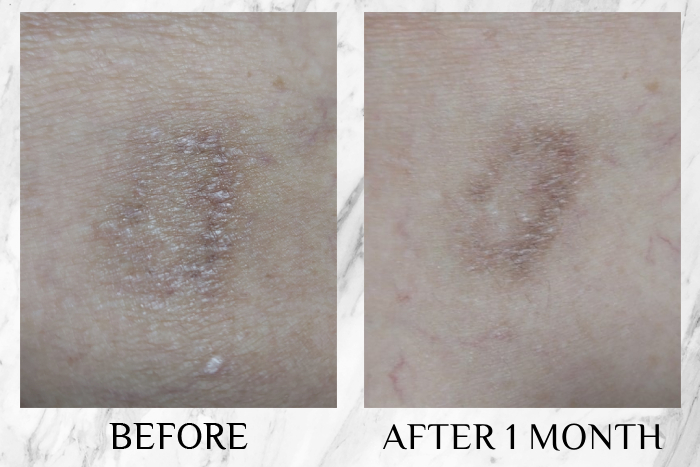 hiruscar ultra scar care gel results andreak chua (1)