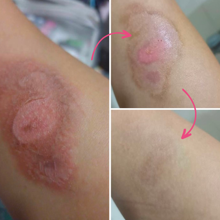 hiruscar ultra scar care gel results nelia