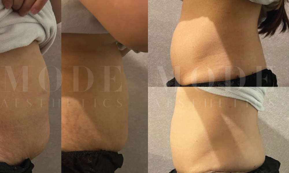 dvbta_ Mode Aesthetics_ Fat Freeze 360