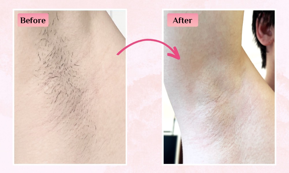 Hair Removal_Japan IPL Express - underarm male