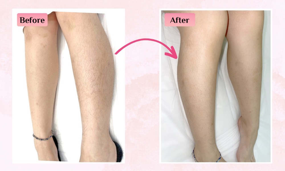 Japan IPL - Hair removal - leg