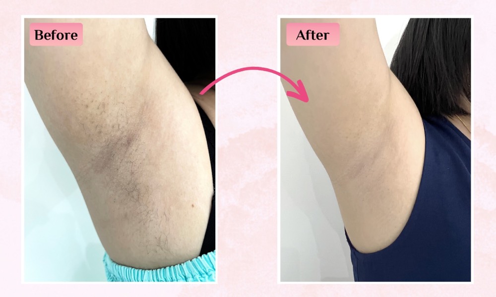 Japan IPL - Hair removal - underarm