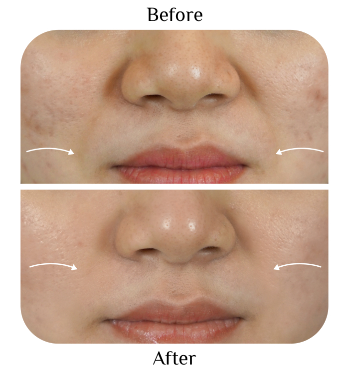 japan ipl trilight therapy before after