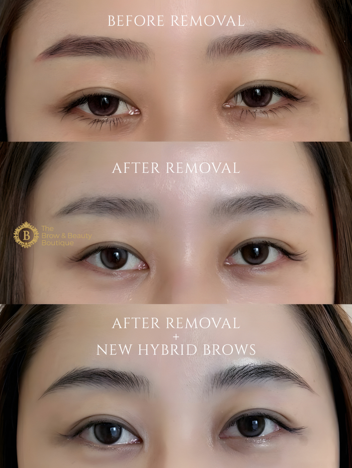 Botched Brows Are More Common Than You Think. Here’s an Eyebrow Removal ...