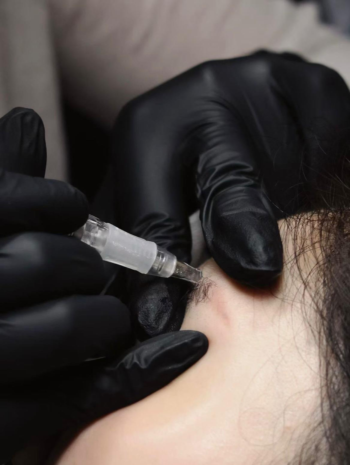 rf pulse eyebrow removal technique