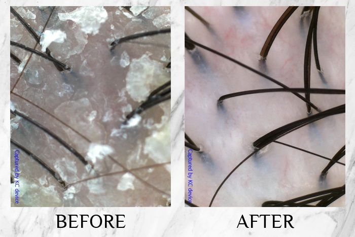 tk trichokare scalp purifying therapy before after (1)