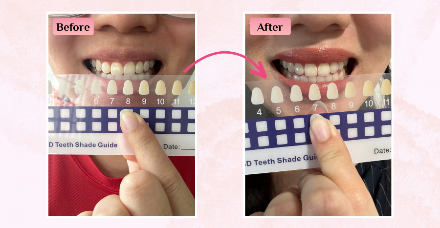 Darlie teeth whitening reviews