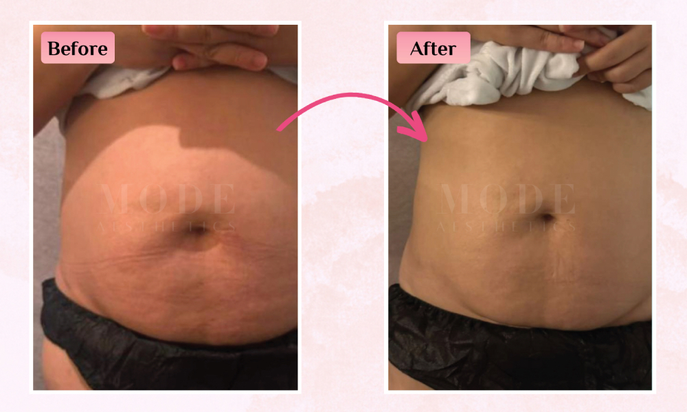 Mode Aesthetic - fat freeze