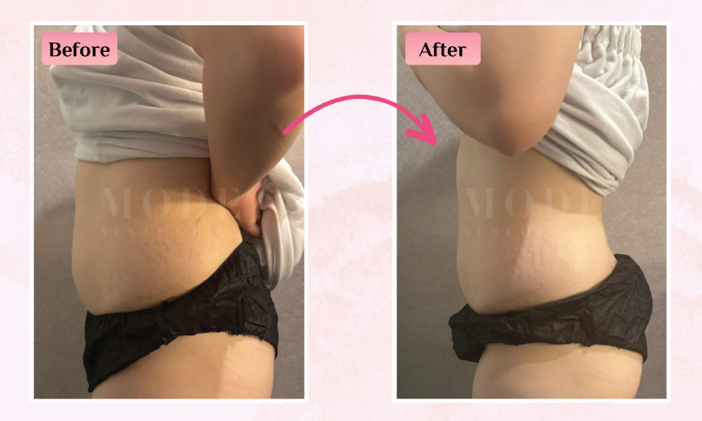 Mode Aesthetics - fat freeze.