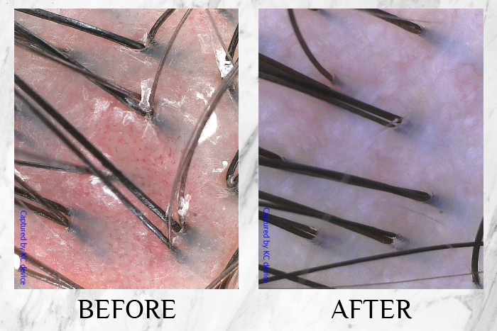 TK TrichoKare Scalp Purifying Therapy Reviews joy