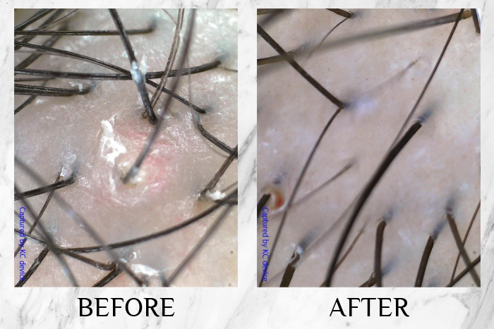 TK TrichoKare Scalp Purifying Therapy Reviews meixin