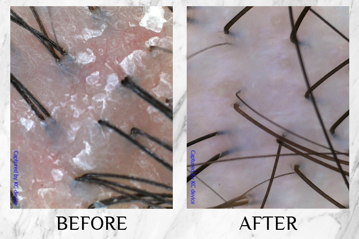 TK TrichoKare Scalp Purifying Therapy Reviews penny