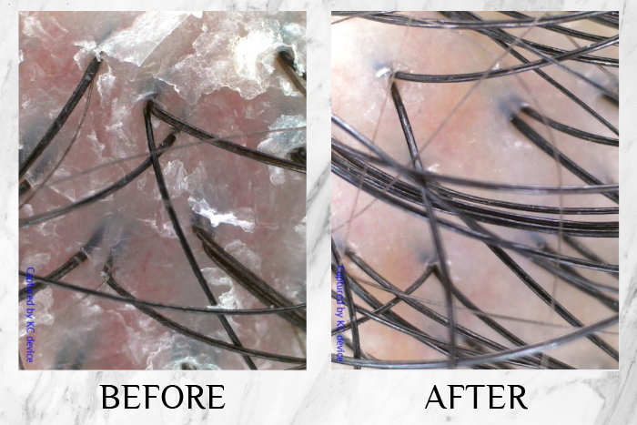 TK TrichoKare Scalp Purifying Therapy Reviews ruiyi