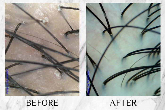 TK TrichoKare Scalp Purifying Therapy Reviews winnie