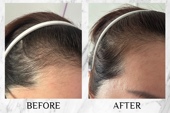 MY SAO HERBAL ANTI-HAIR LOSS ESSENCE before after