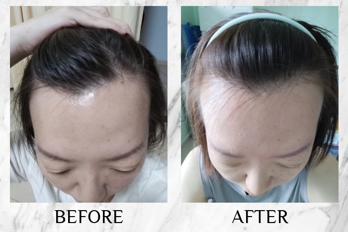MY SAO HERBAL ANTI-HAIR LOSS ESSENCE before after