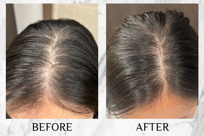 MY SAO HERBAL ANTI-HAIR LOSS ESSENCE before after