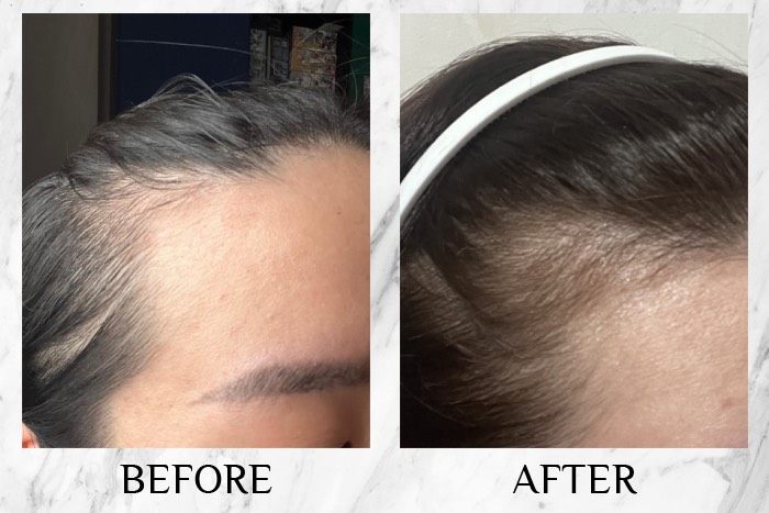 MY SAO HERBAL ANTI-HAIR LOSS ESSENCE before after