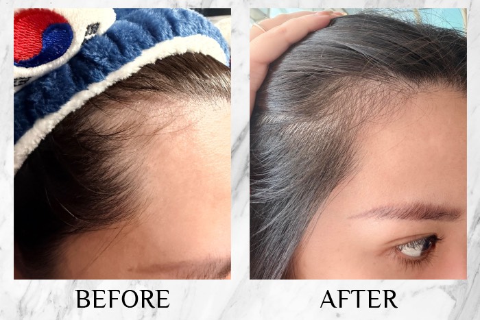MY SAO HERBAL ANTI-HAIR LOSS ESSENCE before after