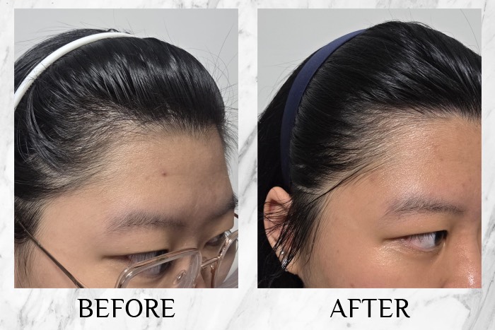 MY SAO HERBAL ANTI-HAIR LOSS ESSENCE before after