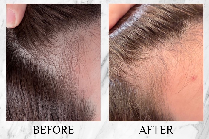 MY SAO HERBAL ANTI-HAIR LOSS ESSENCE before after