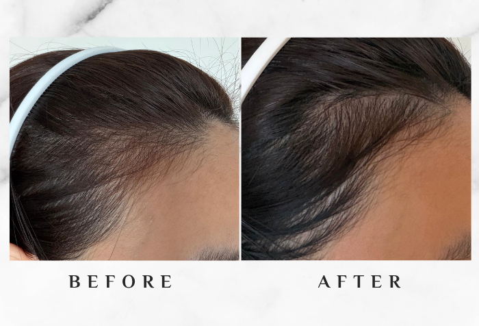 MY SAO HERBAL ANTI-HAIR LOSS ESSENCE before after