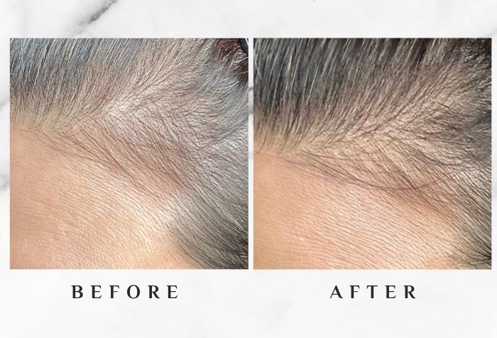 MY SAO HERBAL ANTI-HAIR LOSS ESSENCE before after