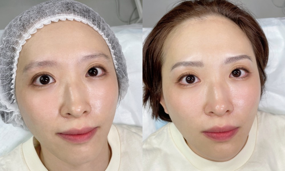 The Beaute Canopy - before_after