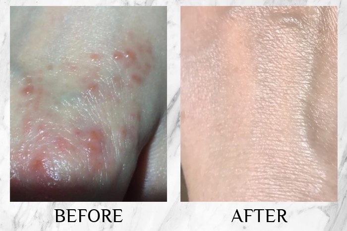 CI Labs Eczema
