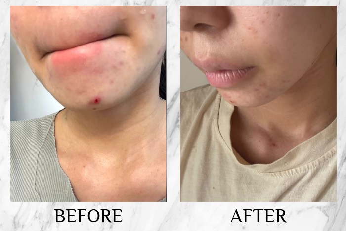 CI Labs Eczema