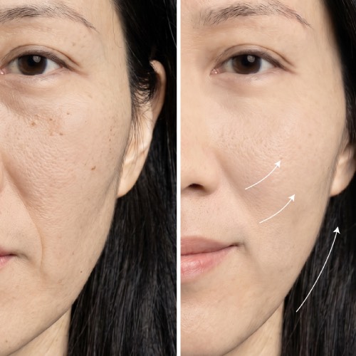 Japan IPL TriLight Therapy before/after