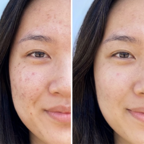 Japan IPL TriLight Therapy before/after