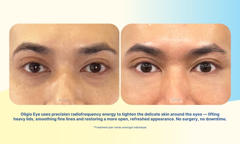 ReDERM Clinic Bangkok - eye treatment