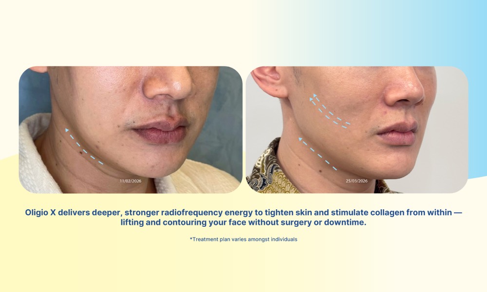 ReDERM Clinic Bangkok - lifting