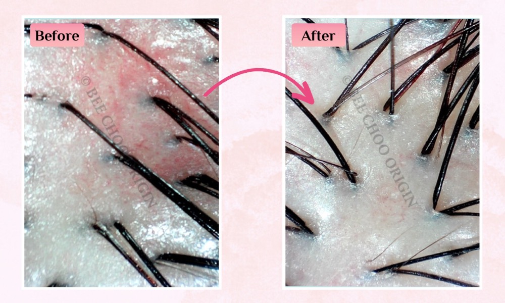 bee choo hair treatment dvbta26 - bef_after