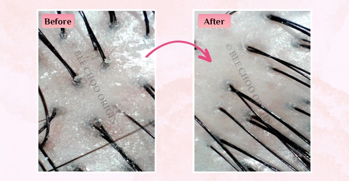 bee choo anti-ageing treatment